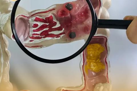 Em 13 anos, doença inflamatória intestinal cresce 5 vezes no Brasil